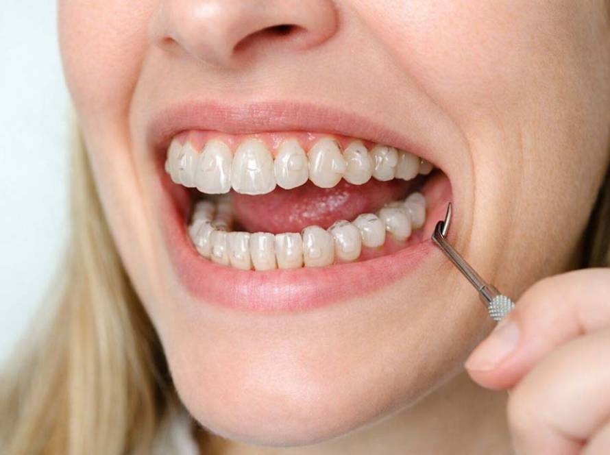 para qué sirven los ataches