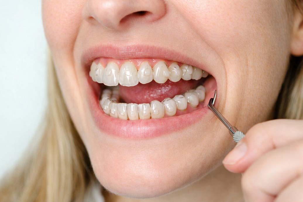 para qué sirven los ataches