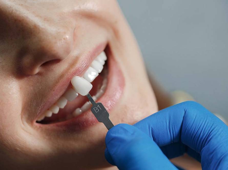 cuánto dura una carilla dental