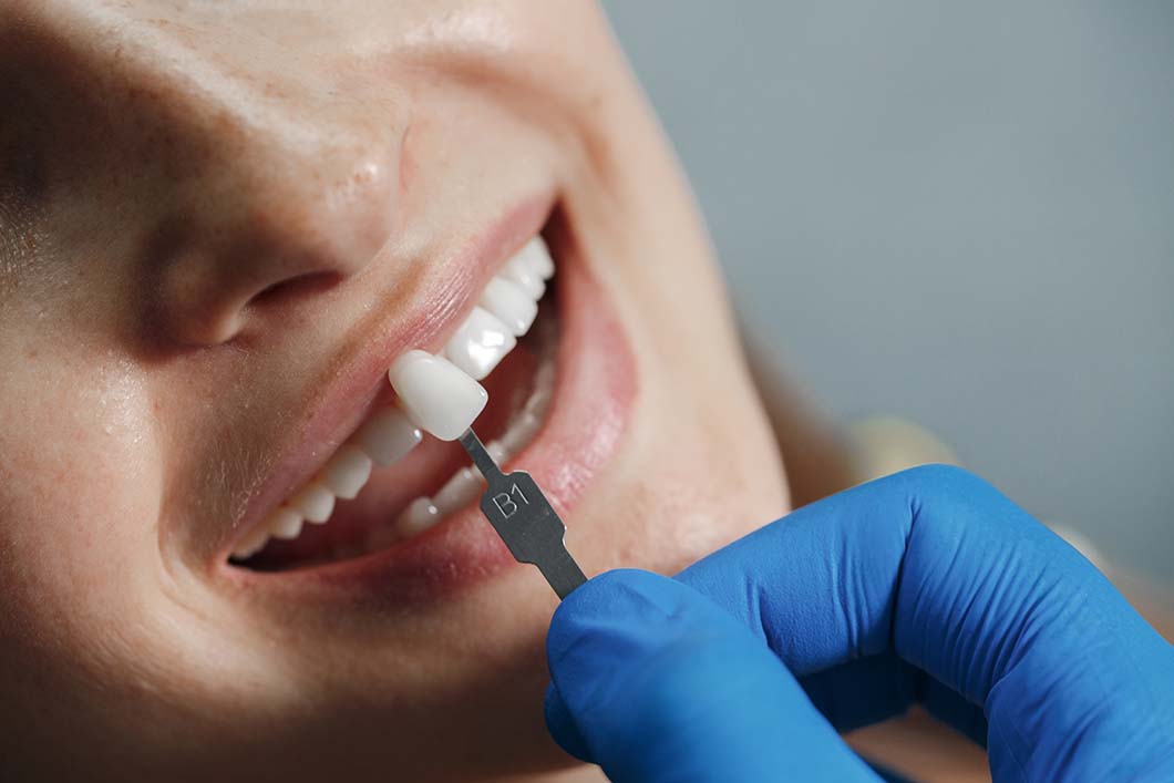 cuánto dura una carilla dental